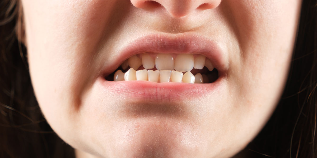 Смещение зубов: причины, что делать