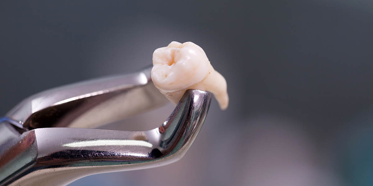 Лечение тройничного нерва после удаления зуба | Стоматологическая клиника 32Dent, Киев