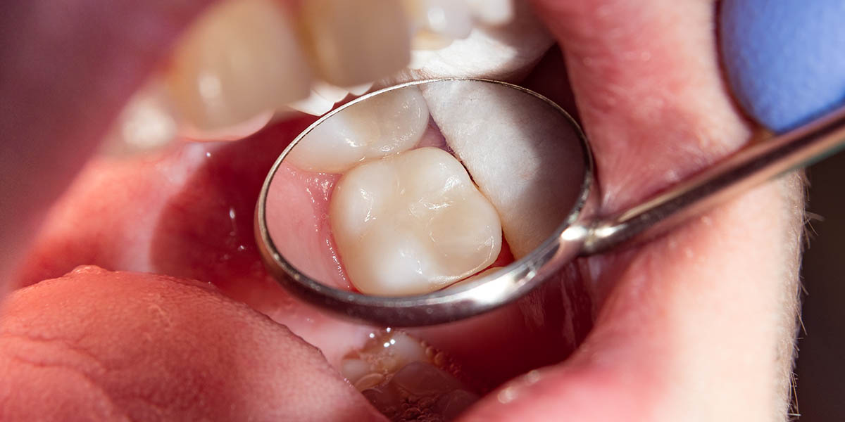Выпала пломба и болит зуб – что делать?