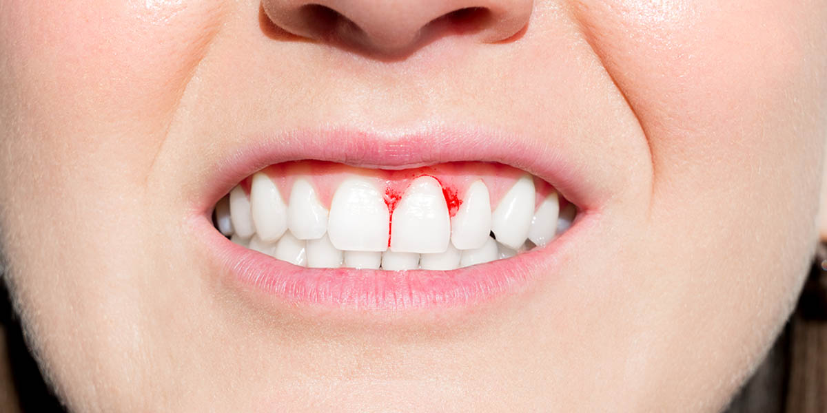 Идет кровь из зуба: причины и способы лечения