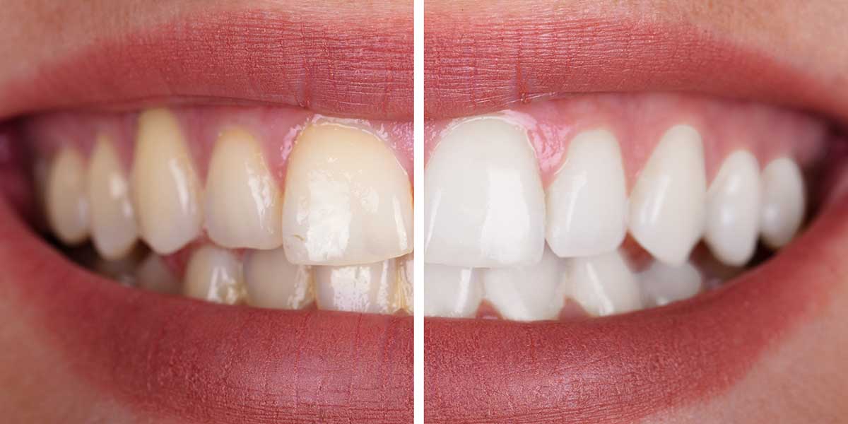 Как снять зубной налет, избавиться от желтизны и коричневого налета на зубах?
