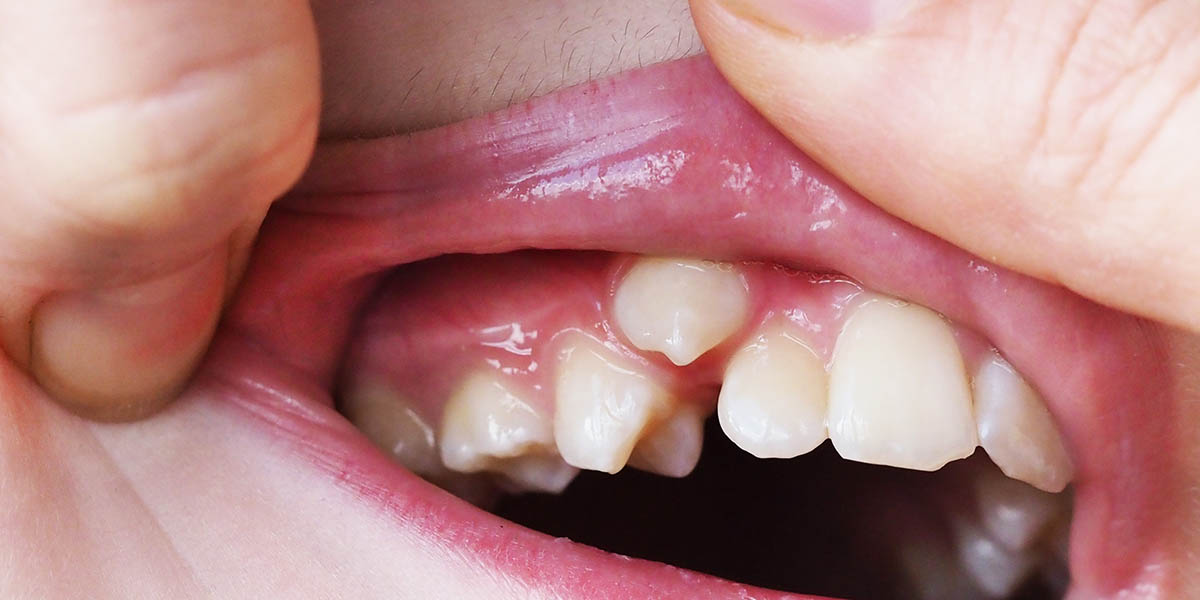 Аномалии зубов: классификация и лечение зубных патологий