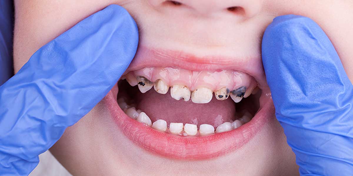 Особенности лечения зубов у детей. Актуальные цены