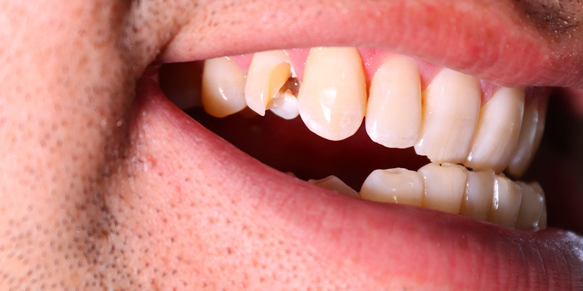 Почему крошатся зубы у взрослых