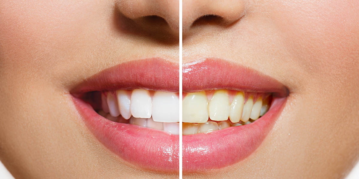 Красивые зубы – как сделать ровные и белые зубы?