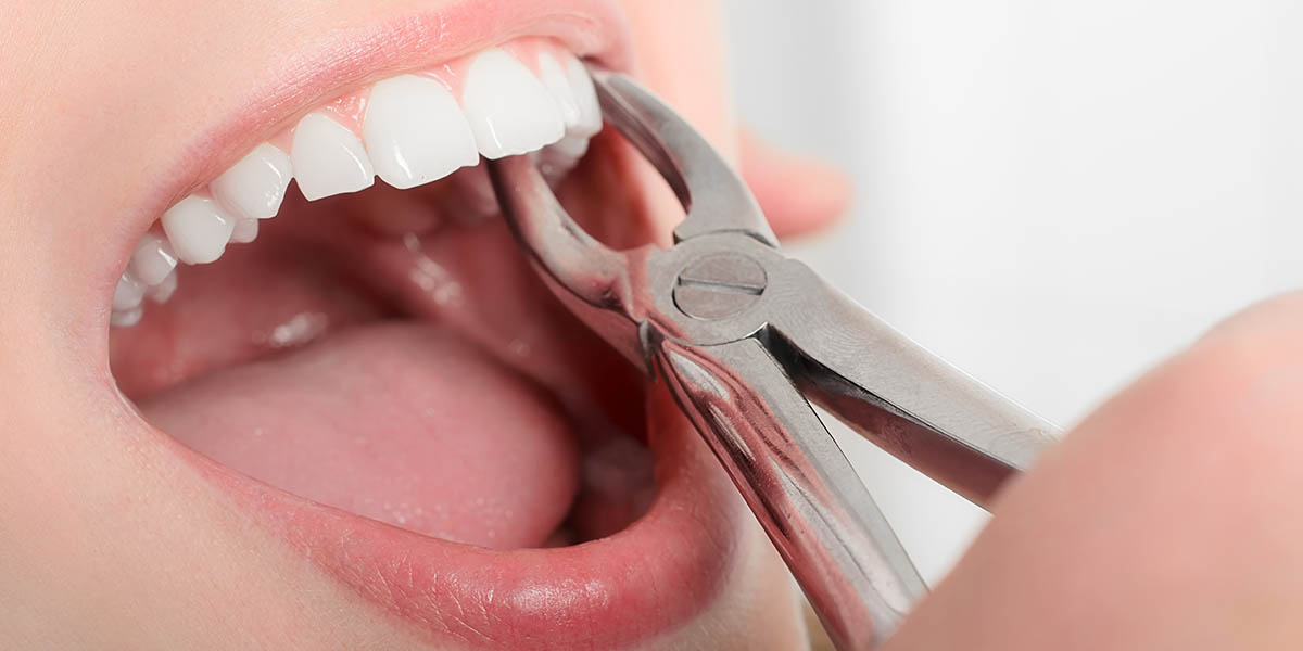 Заживления лунки после удаления зуба | Блог DentArt | Киев