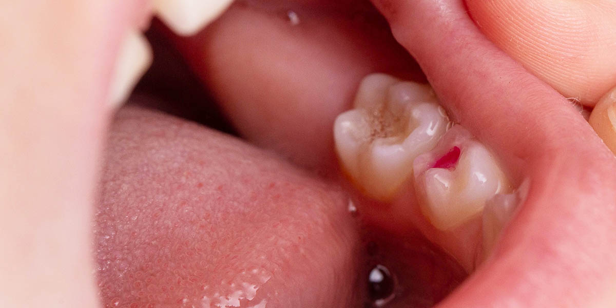 Почему у детей черные зубы