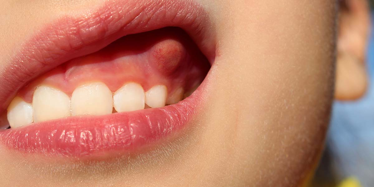 Почему болят десны над зубом: причины и методы лечения
