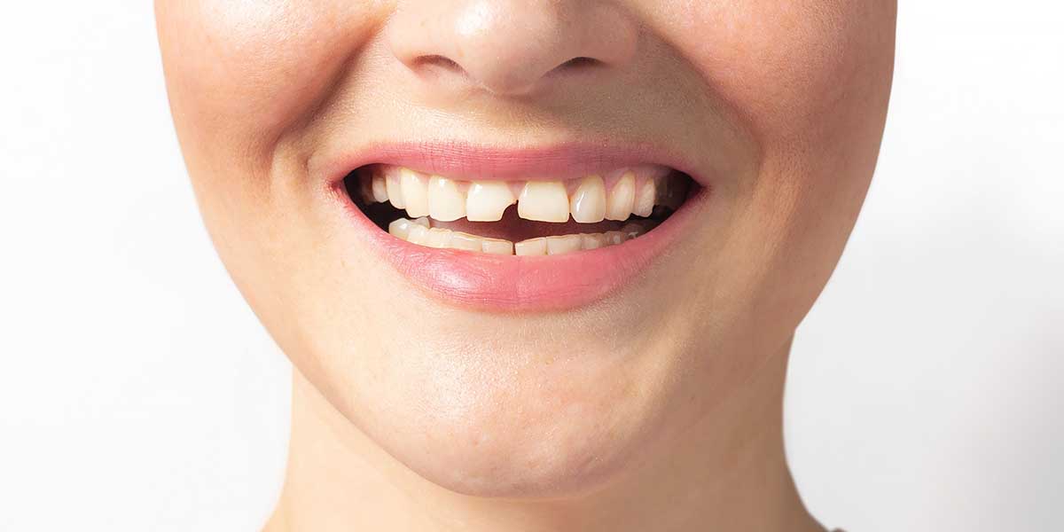 Перелом зуба: виды, симптомы, диагностика, лечение