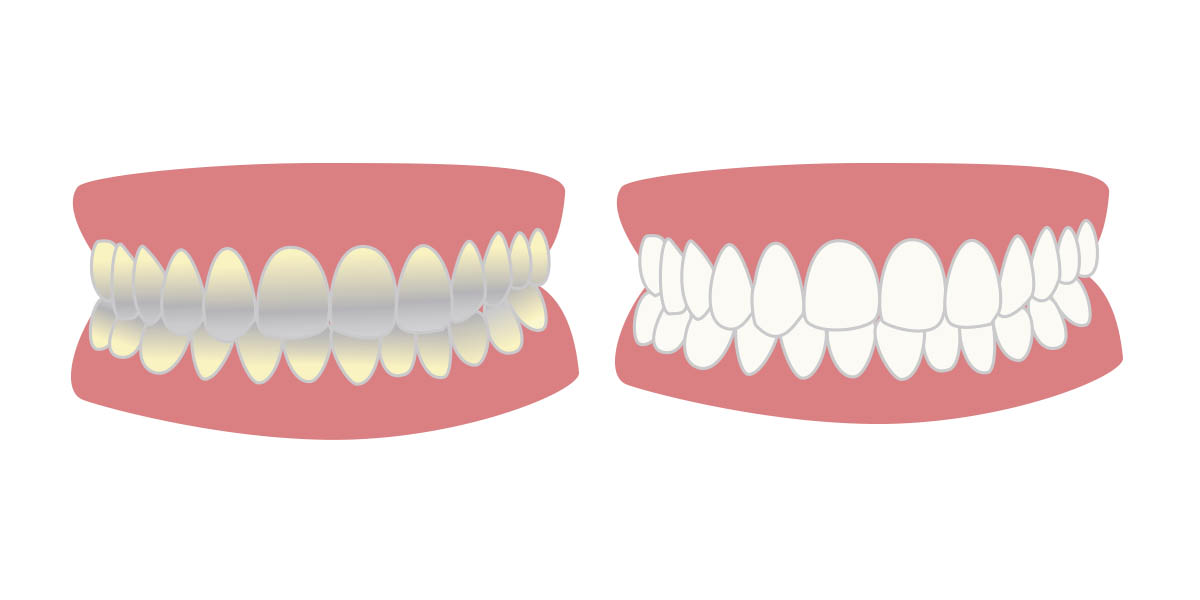 Тетрациклиновые зубы: причины, диагностика, лечение
