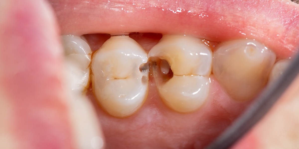 Причины потемнения зубов у ребенка