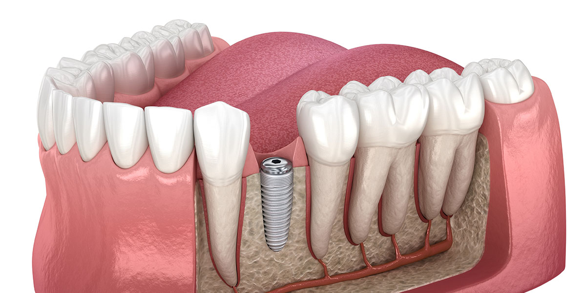 Что такое зубные импланты и процесс их установки — ROOTT