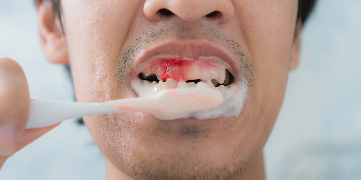 Пасты от кровоточивости десен - рейтинг лучших зубных паст против кровоточивости десен