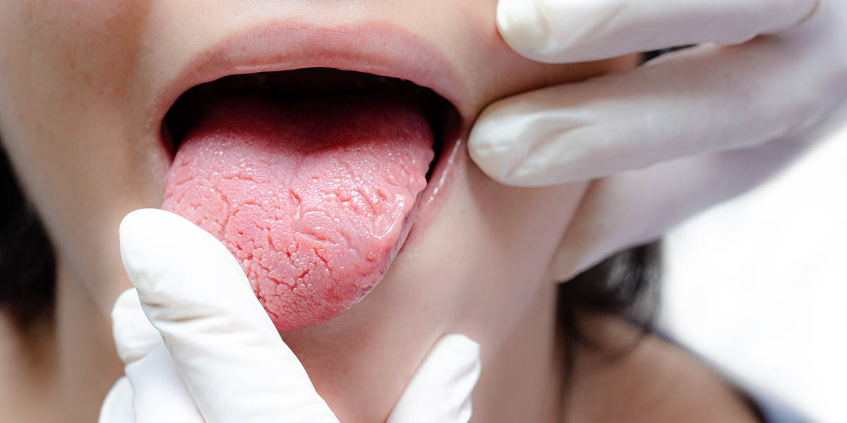 Виды глоссита языка — симптомы и лечение