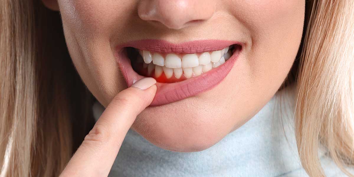 Киста зуба: что такое, ее симптомы, способы лечение, причины возникновения