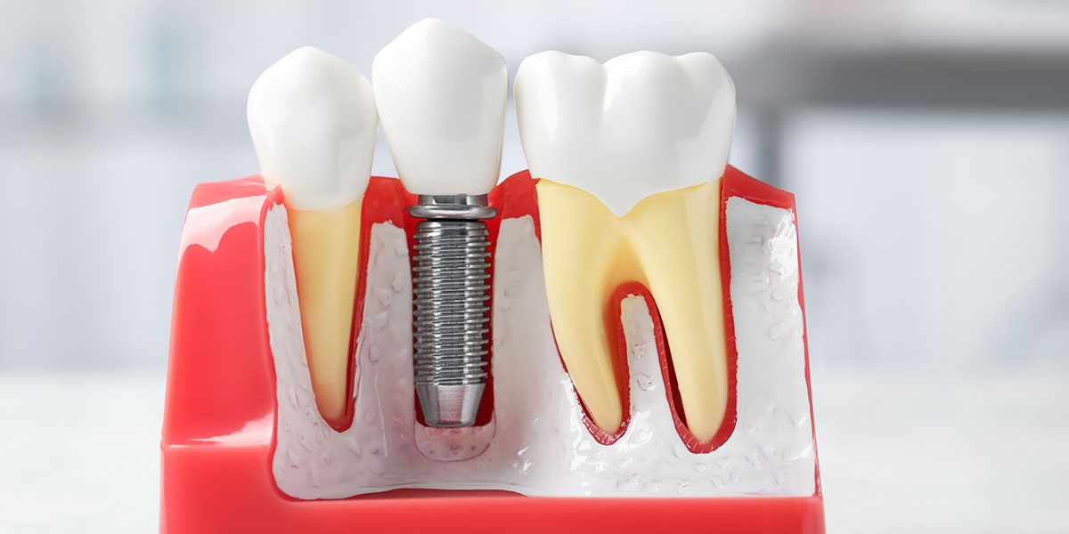 Боль после имплантации зубов: сколько дней болит зуб после установки коронки импланта