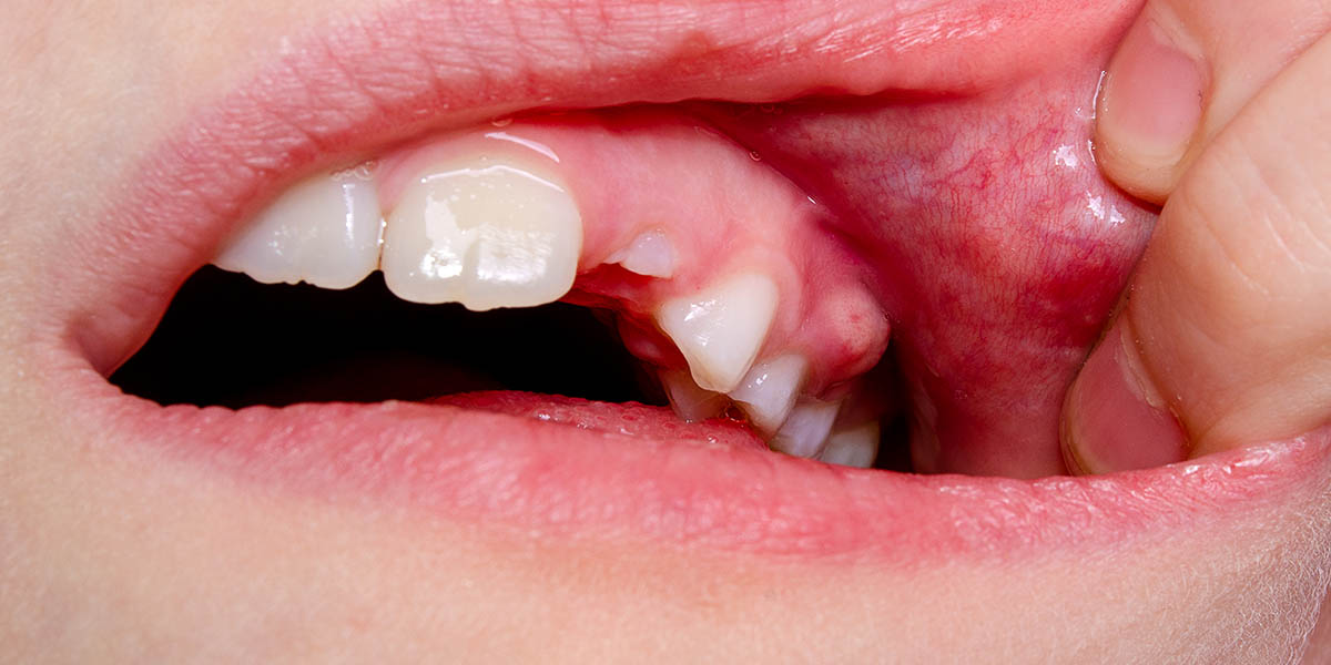 Позднее прорезывание зубов у детей: причины, симптомы, диагностика и лечение