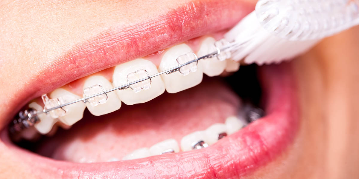 Как ухаживать за зубами с коронками, вкладками или зубными мостами