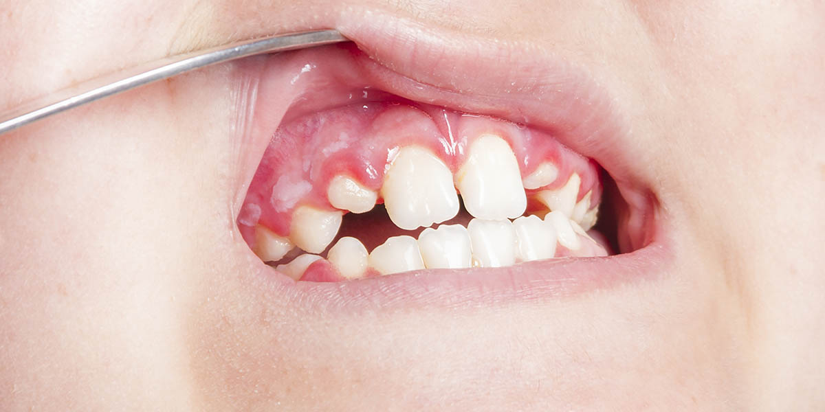 Киста зуба (на десне): причины возникновения, каковы симптомы и лечение