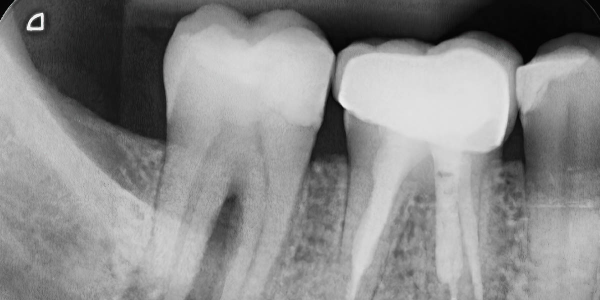 Резорбция зубов