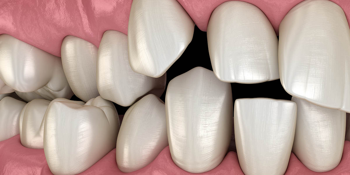 Постановка искусственных зубов при различных прикусах