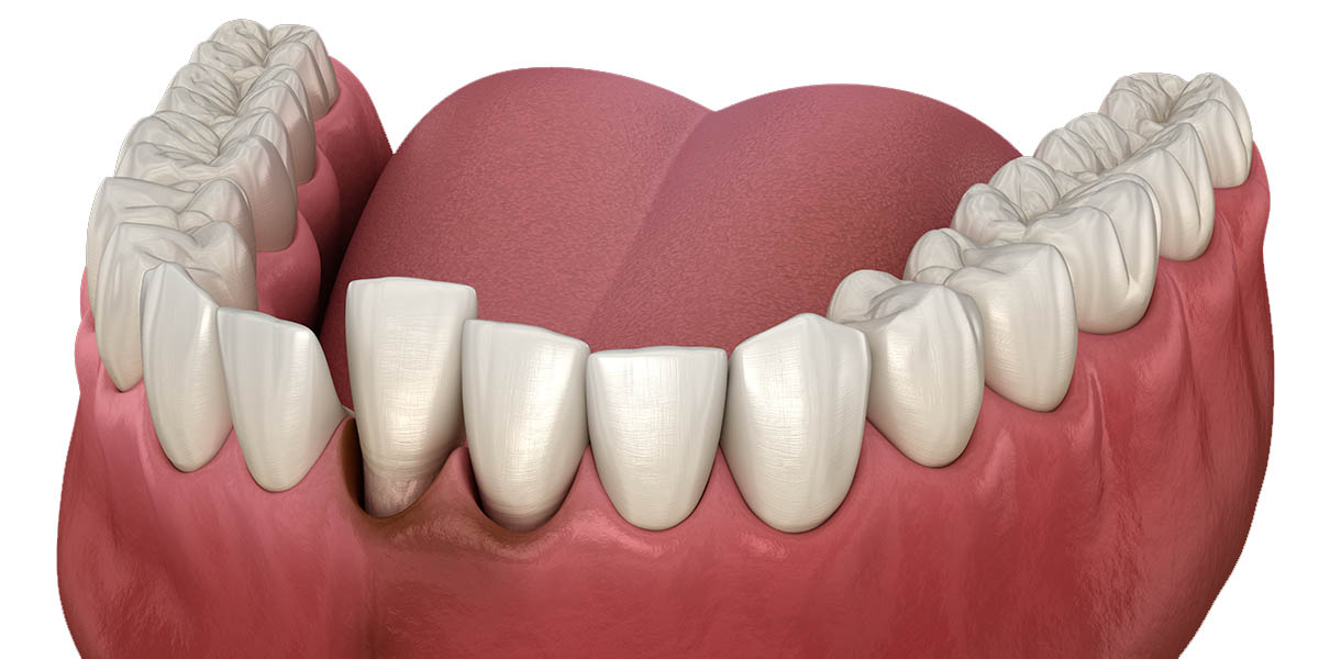 Вывих зуба: диагностика, лечение