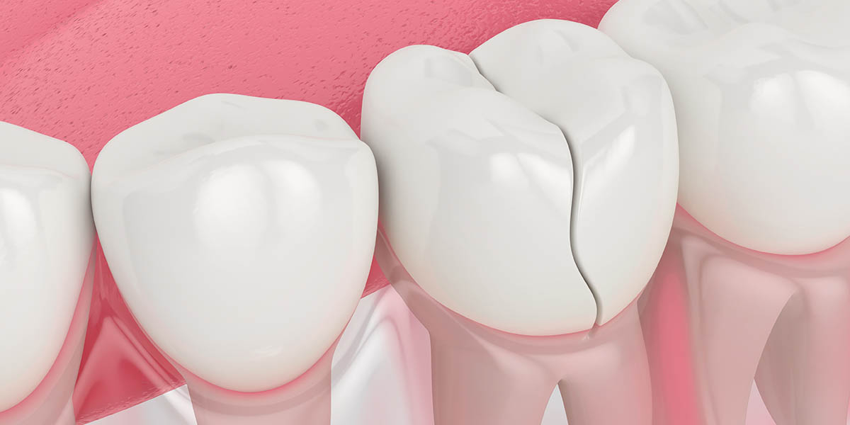 Трещины на зубах: причины, симптомы, диагностика, лечение трещин на эмали зубов