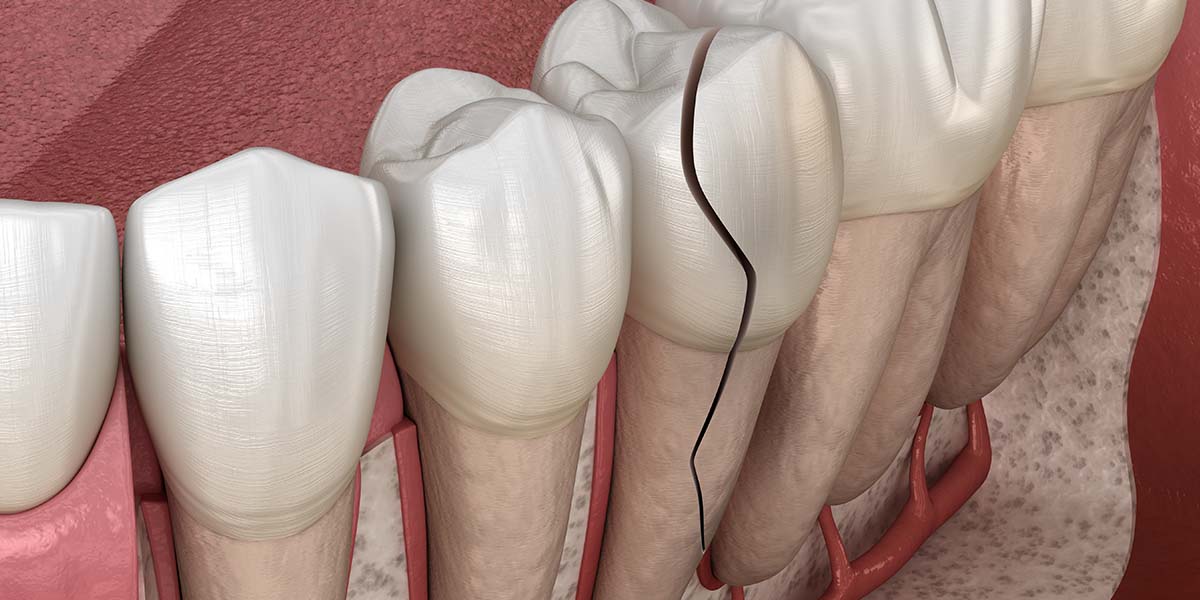 Травмы зубов: какие бывают и что с ними делать