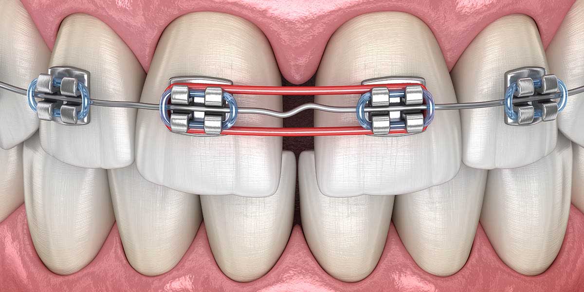 Щель между зубами – как убрать? Почему она появилась?