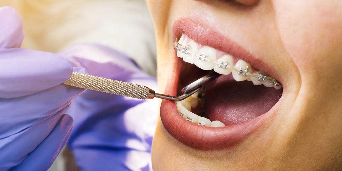 Открытый прикус: причины, симптомы, исправление у взрослых, методы лечения у ортодонта
