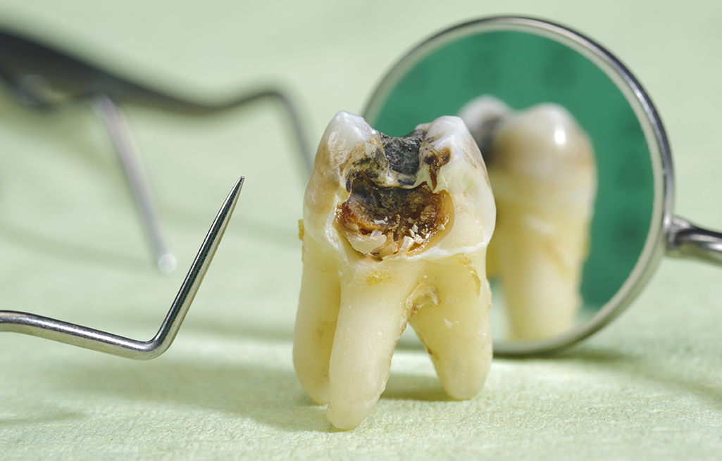 Как лечат кариес? Лечение кариеса в стоматологии | Стоматология 24