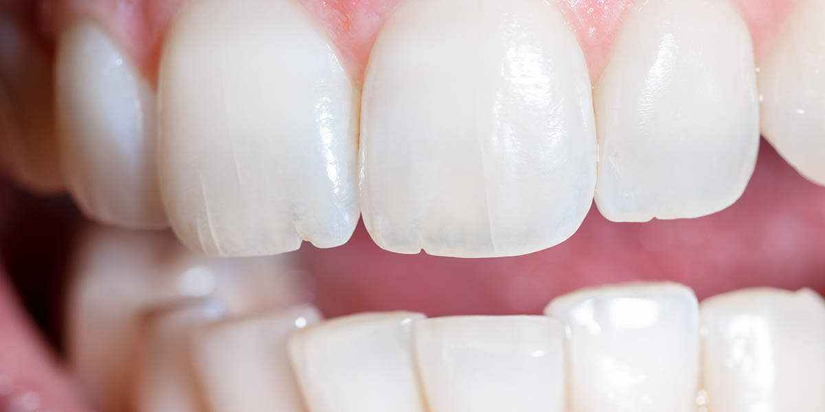 Почему крошатся зубы у детей и взрослых