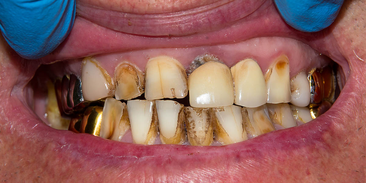 Гнилые зубы: причины и способы лечения