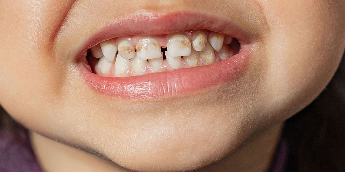 Пятна на зубах: почему появляются, как убрать