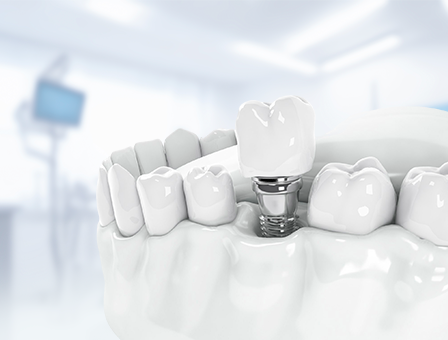 Премиум имплант Nobel