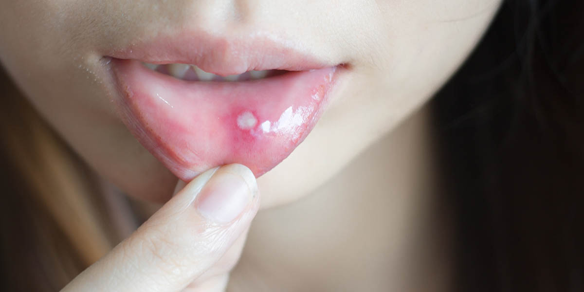 Почему появляются язвы во рту, лечение | Стоматология в Алтуфьево