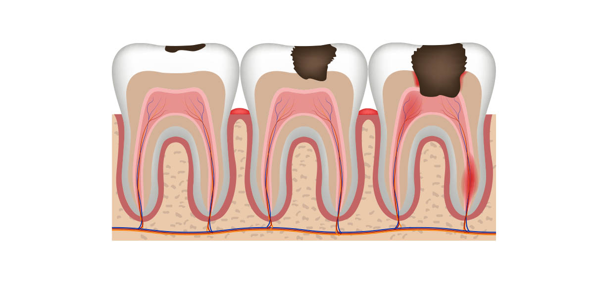 Апикальный периодонтит зуба