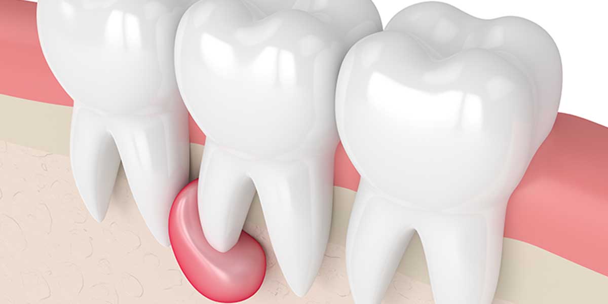 Причины подвижности зубов