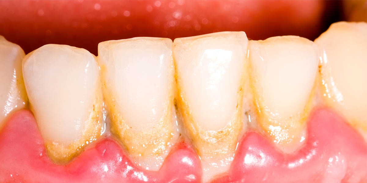 Желтый налет на зубах: причины появления и способы устранения