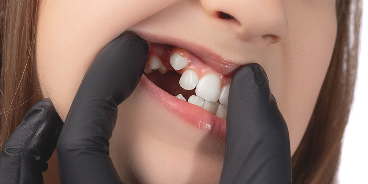 Сроки прорезывания зубов