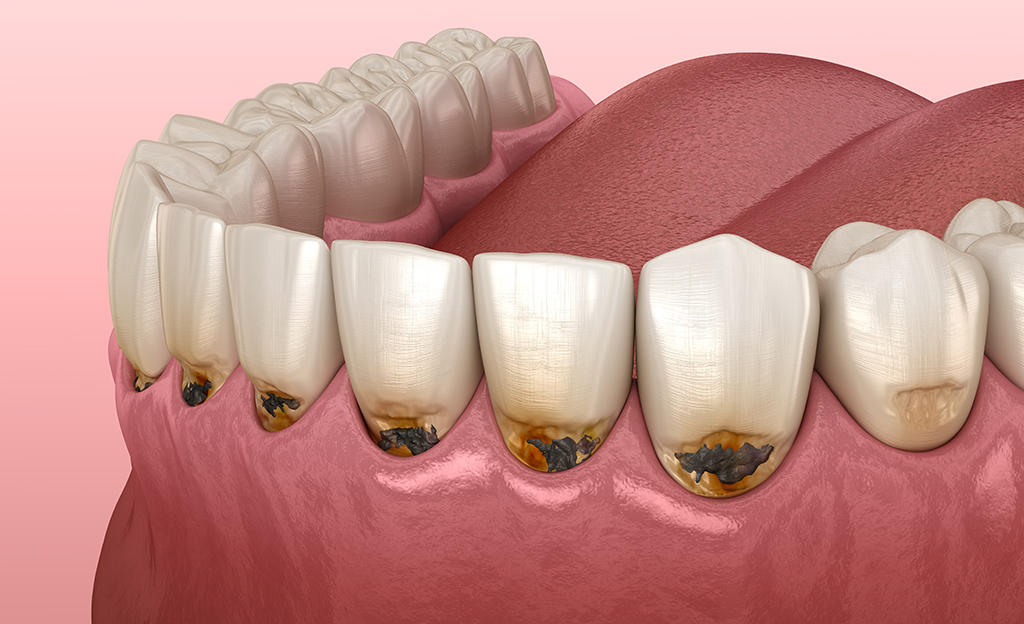 Кариес зуба: классификации, причины возникновения и правильная гигиена