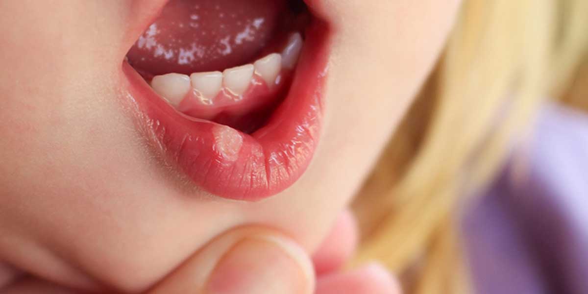 Стоматит во рту: как лечить у взрослых