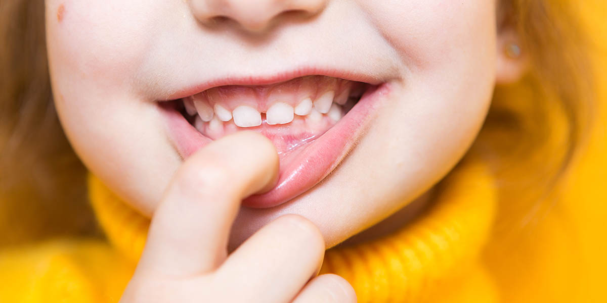 Почему у ребенка чернеют молочные зубы