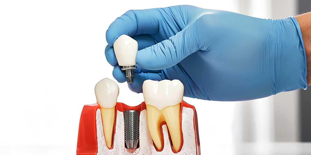 Рекомендации по имплантации зубов