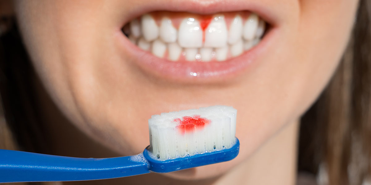 Кровоточат десны при чистке зубов: причины и лечение
