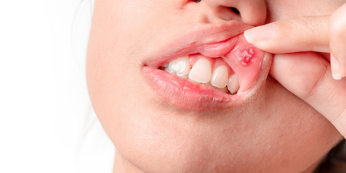 Стоматит и другие воспаления слизистой полости рта у взрослых | colgate®