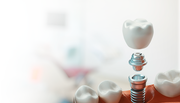 Имплантация с установкой коронки на системе Dentium «под ключ» – 89 900 руб.