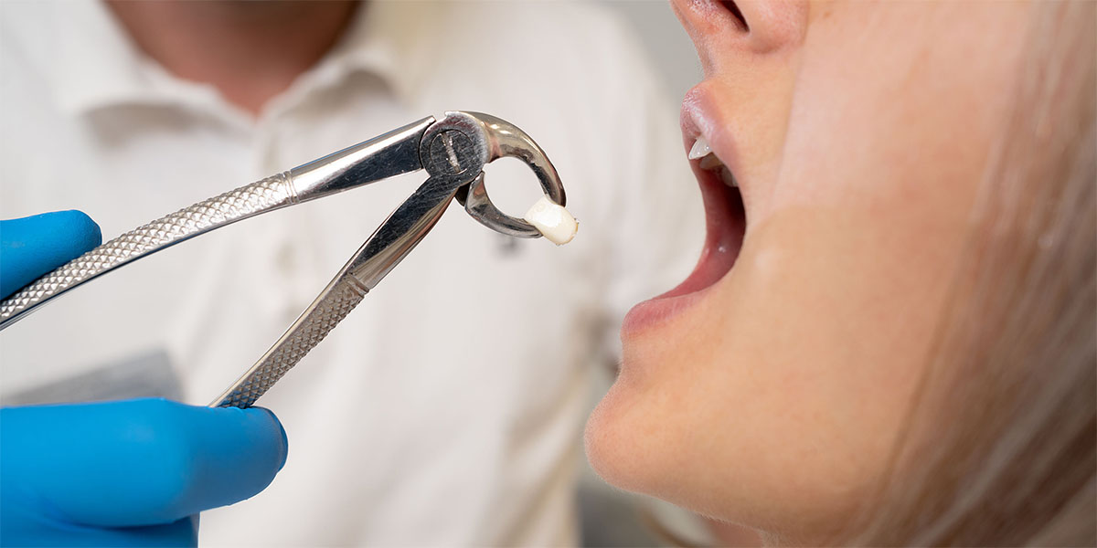 После удаления зубов: образ жизни, питание и правила гигиены - рекомендации специалистов