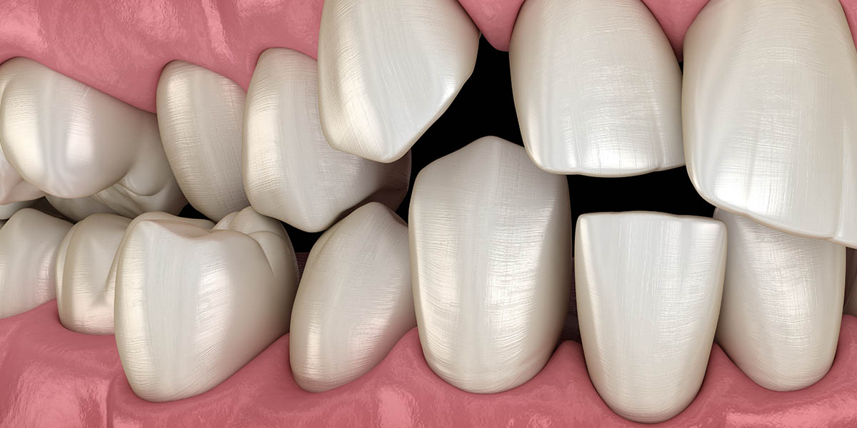 Сверхкомплектные зубы: причины и лечение полиодонтии
