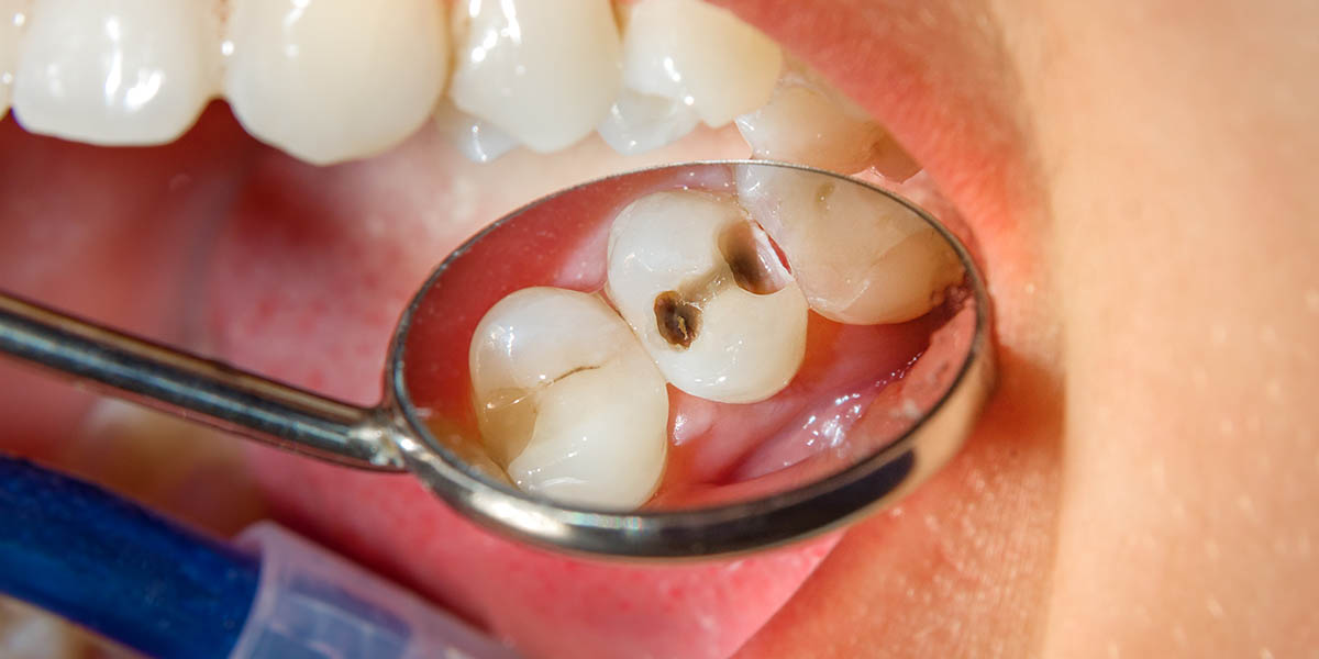 Особенности лечения зубов у детей. Актуальные цены